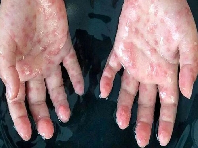 واکسن آبله میمون ۱۰۰ درصد در پیشگیری از بیماری موثر نیست