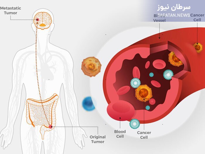 متاستاز