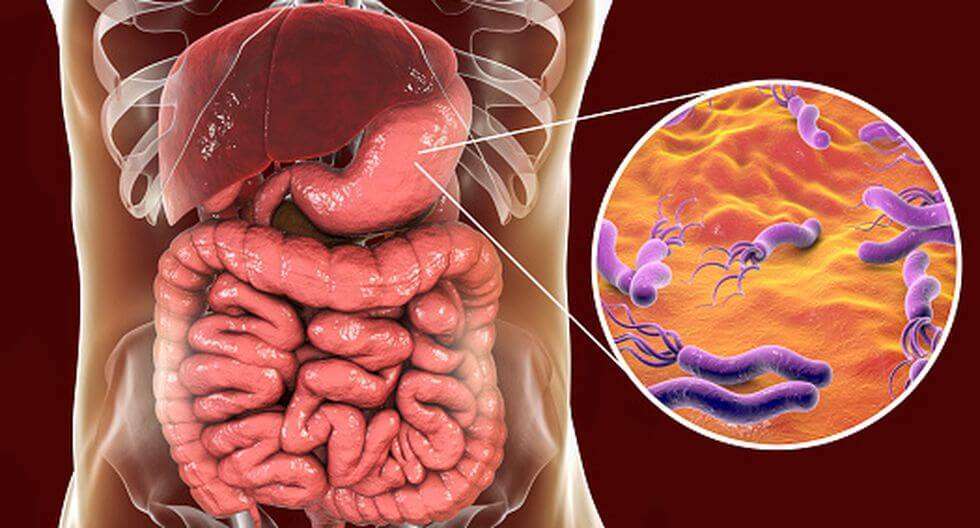عفونتی که ریشه کنی آن می‌تواند باعث کاهش ابتلا به سرطان معده شود
