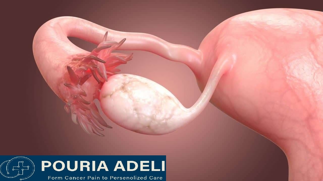 نقش لنفادنکتومی در درمان کارسینوم تخمدان سروزباسرعت رشد پایین