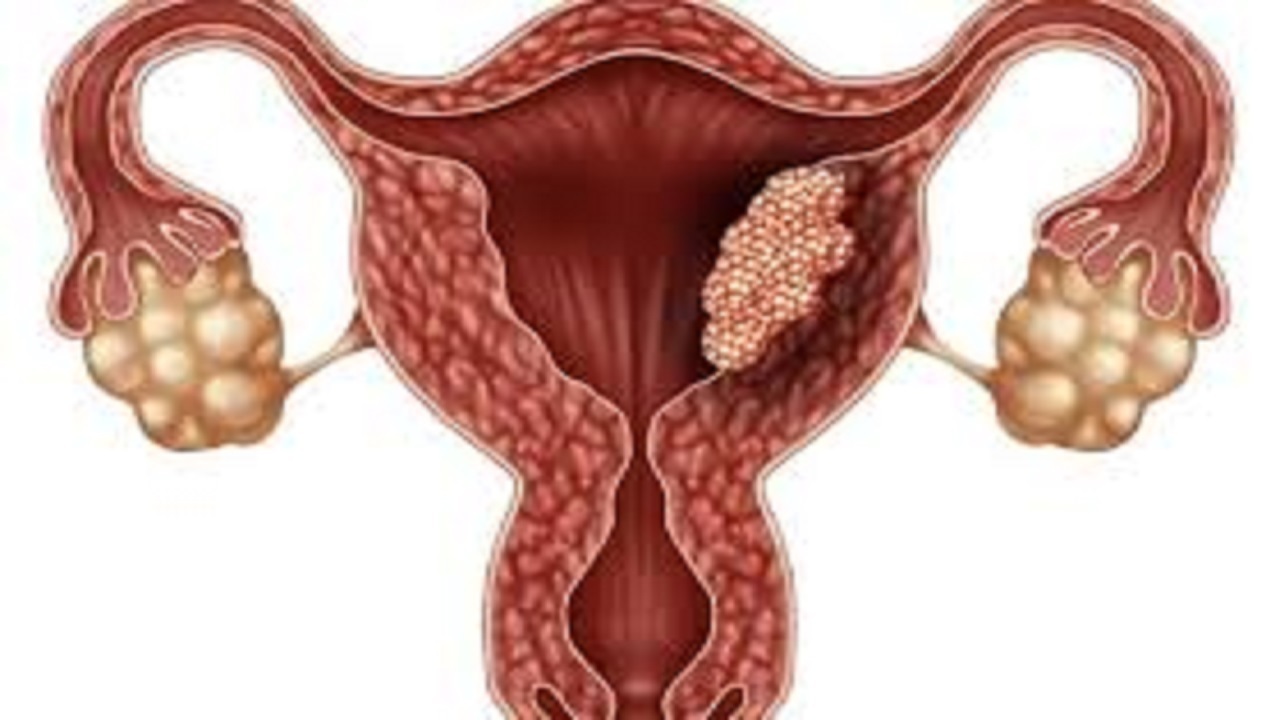 بیوپسی غدد لنفاوی سنتینل جایگزین لنفادنکتومی گسترده شد
