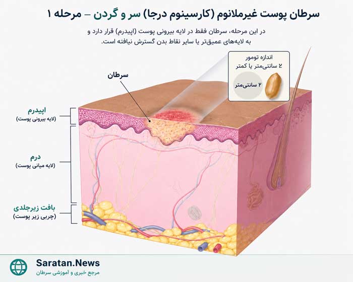 **شکل. سرطان پوست غیرملانومی سر و گردن در مرحله I:** در این مرحله، تومور تشکیل شده است و اندازه آن **۲ سانتیمتر یا کوچکتر** است. **شکل. سرطان پوست غیرملانومی سر و گردن در مرحله I:** در این مرحله، تومور تشکیل شده است و اندازه آن **۲ سانتیمتر یا کوچکتر** است.
