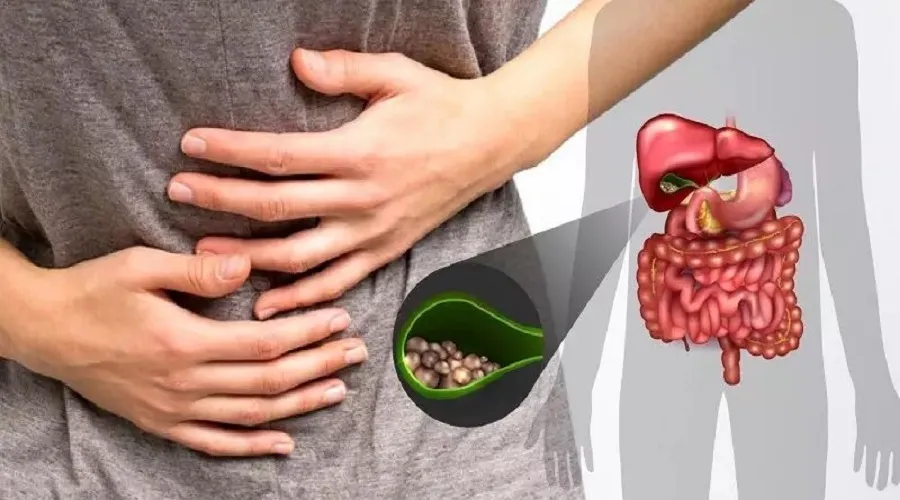 آیا سنگ کیسه صفرا باعث لک صورت میشود؟