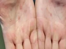 راه‌اندازی شبکه تشخیصی تب کریمه کنگو در کشور/ مشاوره ایران به کشور‌های همسایه