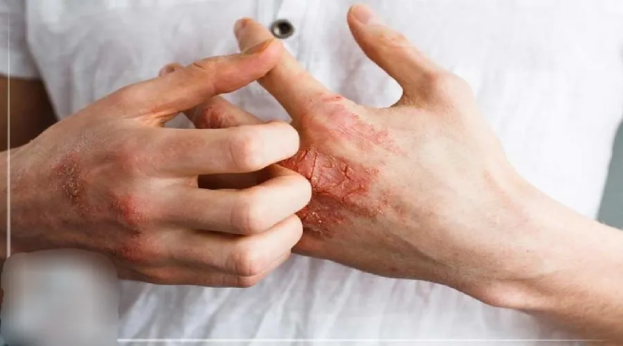 سلیاک؛ بیماری هزار چهره