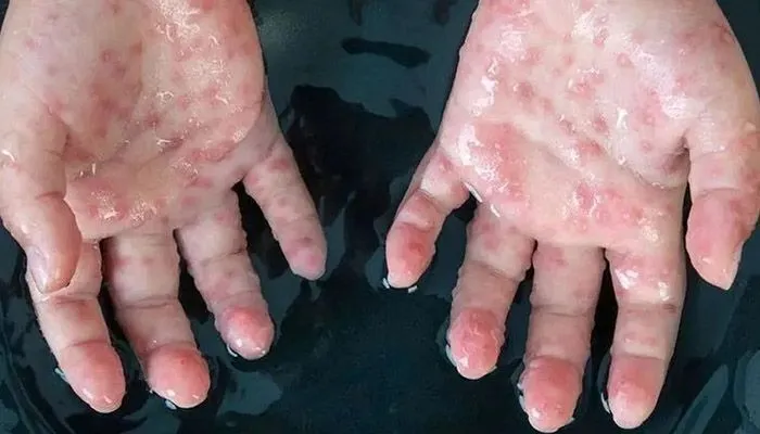 بررسی اعلام وضعیت اضطراری در جهان با همه گیری مجدد آبله میمون
