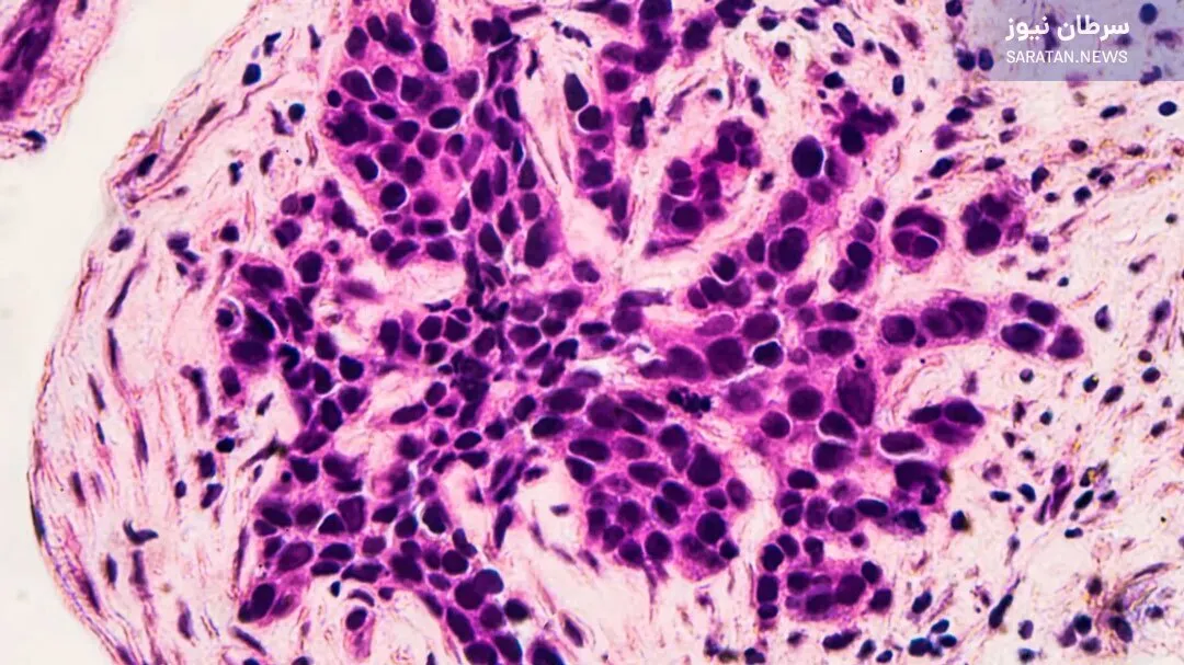 آزمایش BRCA چیست و چرا برای پیشگیری از سرطان پستان مهم است؟