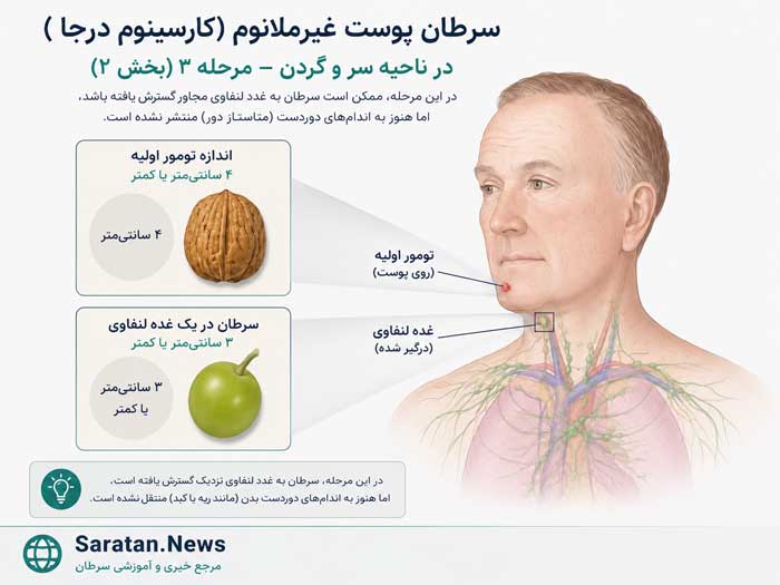 شکل. سرطان پوست غیرملانومی سر و گردن در مرحله III (۲): در این مرحله، اندازه تومور ۴ سانتیمتر یا کوچکتر است، اما سرطان به یک غده لنفاوی در همان سمت بدن که تومور قرار دارد گسترش یافته است و اندازه غده لنفاوی ۳ سانتیمتر یا کوچکتر است. شکل. سرطان پوست غیرملانومی سر و گردن در مرحله III (۲): در این مرحله، اندازه تومور ۴ سانتیمتر یا کوچکتر است، اما سرطان به یک غده لنفاوی در همان سمت بدن که تومور قرار دارد گسترش یافته است و اندازه غده لنفاوی ۳ سانتیمتر یا کوچکتر است.