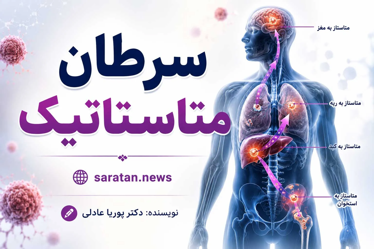 سرطان متاستاتیک چیست و چگونه در بدن گسترش می‌یابد؟