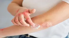 کمبود اسپری‌های آسم جدی است