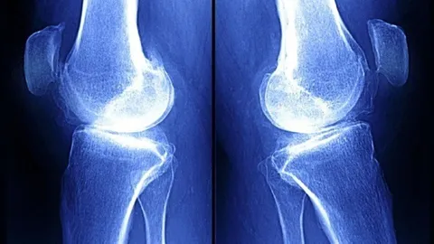 هوش مصنوعی جدید، عکس X-ray زانوی شما در یک سال آینده را نشان می‌دهد