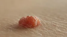 تایید واکسن جدید HPV تک‌دوز توسط WHO برای پیشگیری از سرطان دهانه رحم