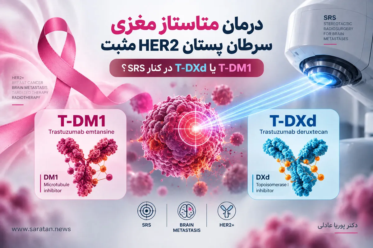 درمان متاستاز مغزی سرطان پستان HER2 مثبت؛ T-DM1 یا T-DXd در کنار SRS؟