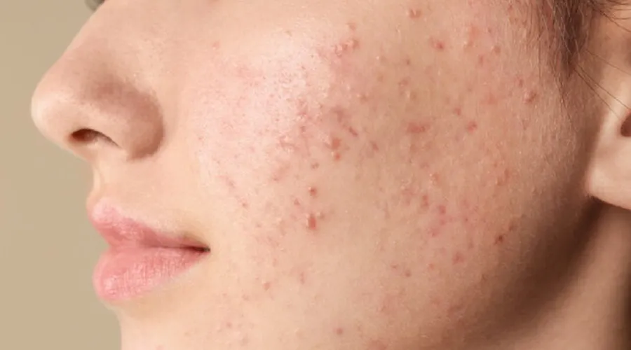 آیا استفاده از خمیردندان برای از بین بردن جوش صورت موثر است؟