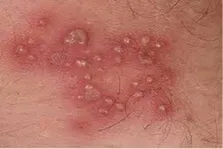 تبلیغات نادرست و پرخطر درمان HPV در شبکه‌های اجتماعی