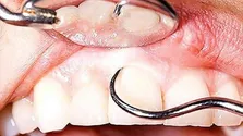 زبان سفید چه چیزی درباره سلامت می‌گوید؟