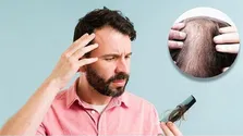 استرس عامل اصلی ریزش مو