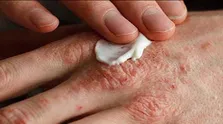 حمایت WHO از برنامه ایمن سازی کشوری در ایران