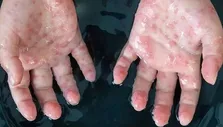 ویروس باستانی آبله را بشناسیم
