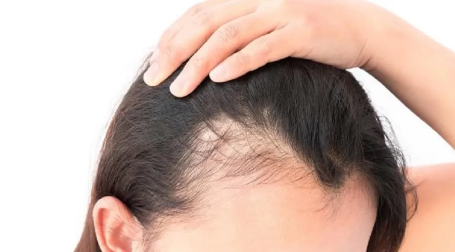 آیا می‌توان از ریزش مو جلوگیری کرد؟