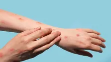 آبله میمونی کشنده نیست/ از تماس با حیوانات خودداری کنید