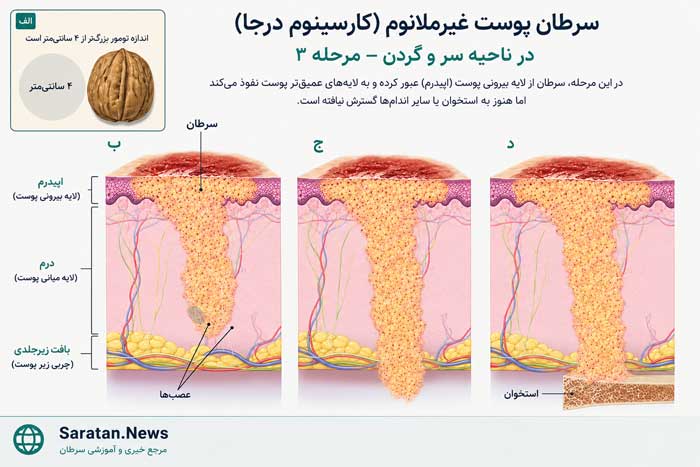 شکل. سرطان پوست غیرملانومی سر و گردن در مرحله III (۱): در این مرحله، یکی از شرایط زیر وجود دارد: (الف) اندازه تومور بیش از ۴ سانتیمتر است؛ یا سرطان به (ب) بافت پوشاننده اعصاب در زیر لایه درم، (ج) بافت زیرجلدی، یا (د) استخوان گسترش یافته و موجب آسیب خفیف استخوان شده است. همچنین، سرطان ممکن است به یک غده لنفاوی در همان سمت بدن که تومور قرار دارد گسترش یافته باشد؛ در این صورت، اندازه غده لنفاوی حداکثر ۳ سانتیمتر است و سرطان از کپسول (پوشش خارجی) غده لنفاوی عبور نکرده است. شکل. سرطان پوست غیرملانومی سر و گردن در مرحله III (۱): در این مرحله، یکی از شرایط زیر وجود دارد: (الف) اندازه تومور بیش از ۴ سانتیمتر است؛ یا سرطان به (ب) بافت پوشاننده اعصاب در زیر لایه درم، (ج) بافت زیرجلدی، یا (د) استخوان گسترش یافته و موجب آسیب خفیف استخوان شده است. همچنین، سرطان ممکن است به یک غده لنفاوی در همان سمت بدن که تومور قرار دارد گسترش یافته باشد؛ در این صورت، اندازه غده لنفاوی حداکثر ۳ سانتیمتر است و سرطان از کپسول (پوشش خارجی) غده لنفاوی عبور نکرده است.