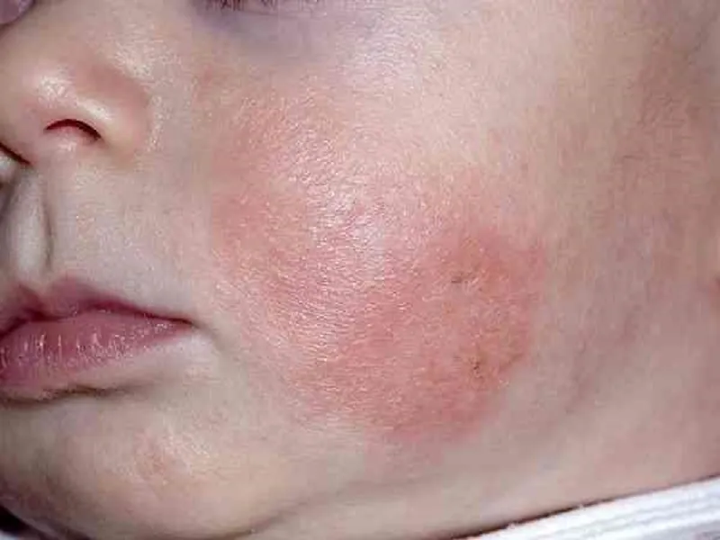 نکاتی برای کنترل اگزما در نوزادان