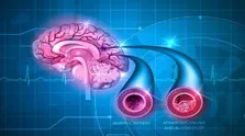 مصرف استاتین ها در جلوگیری از تکرار سکته مغزی موثر است
