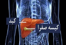چاقی دومین علت ایجاد سنگ صفرا در دنیا + فیلم