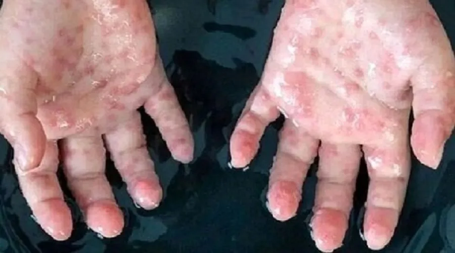 افزایش موارد ابتلا به آبله میمون در آفریقای جنوبی