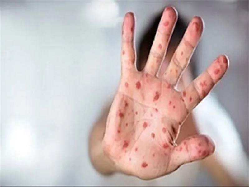 حذف سرخک با واکسیناسیون کامل کودکان ایرانی و غیر ایرانی