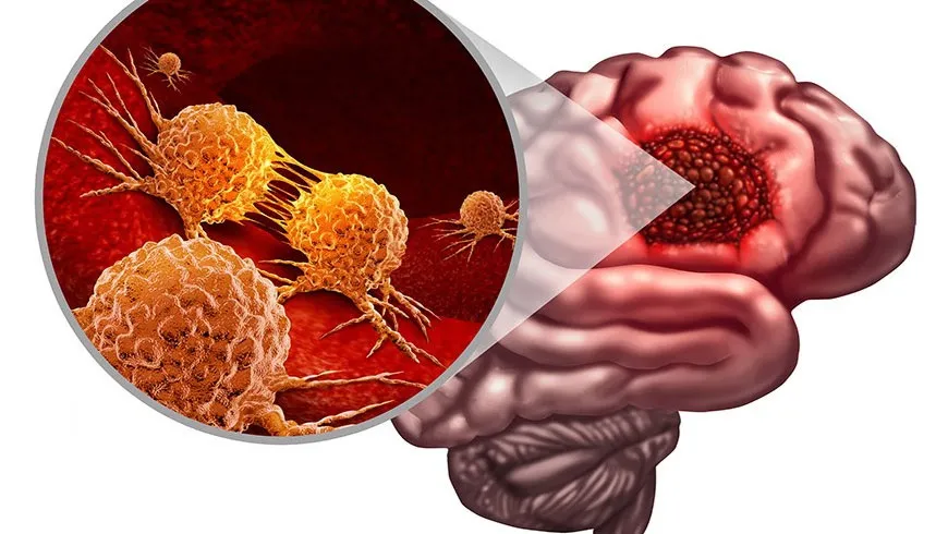 اسب تروای پنهان در قلب گلیوبلاستوما