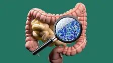 روند پیشروی پارکینسون چگونه کند می‌شود؟