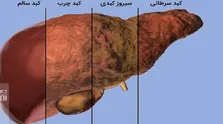 هوش مصنوعی راه درمان یک سرطان را پیدا کرد!
