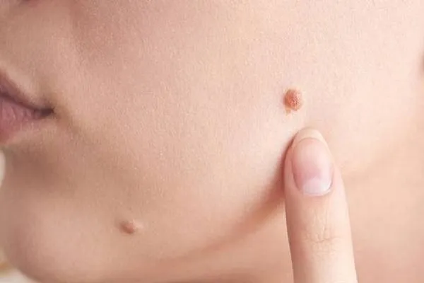 انواع خال‌های پوستی در بزرگسالان به چه صورت است؟