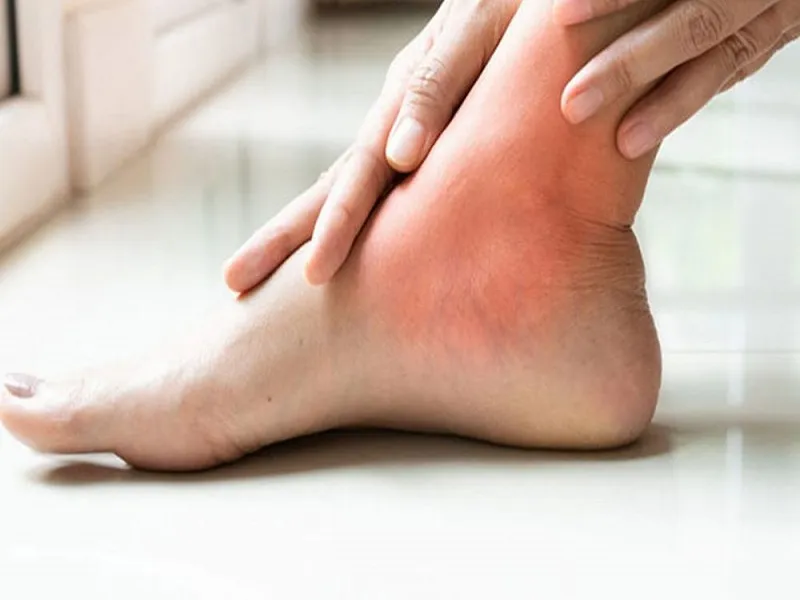 نقرس چه زمانی رخ می‌دهد؟
