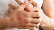 اگزمای شدید بی‌خوابی می‌آورد