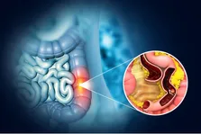 تحولی در درمان سرطان کولورکتال MSS/pMMR: تحلیل داده‌های فاز ۱/۲ ترکیب EO۴۰۱۰ و Nivolumab در نشست ASCO ۲۰۲۵