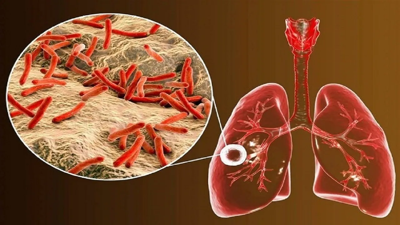 چگونه از بیماری سل پیشگیری کنیم؟ + فیلم