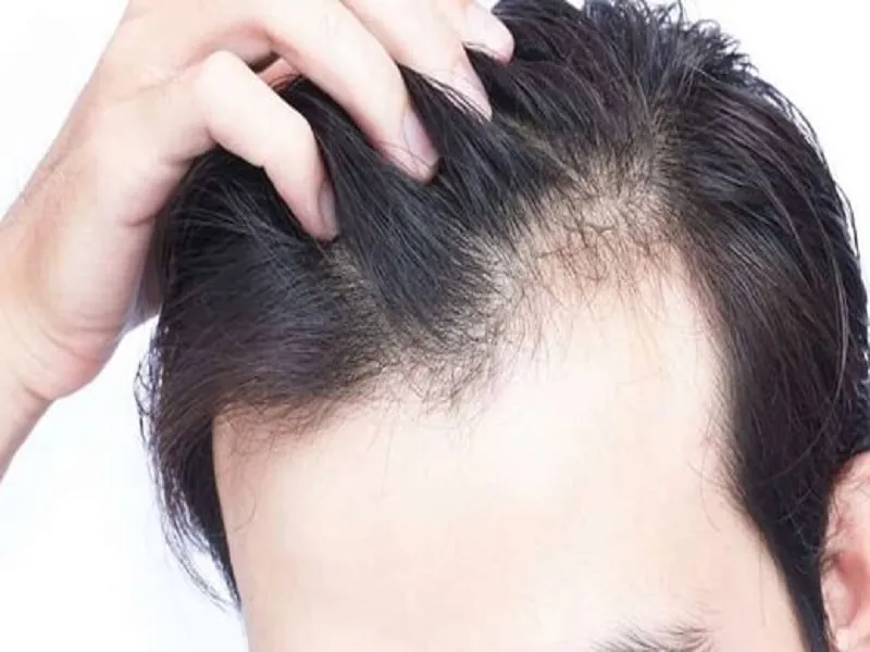 چند راهکار ساده برای جلوگیری از ریزش مو