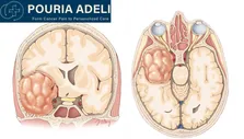 گلیوبلاستوم مولکولی چیست و چه تفاوتی با نوع کلاسیک دارد؟