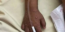 علائم جدید بیماری آبله میمونی