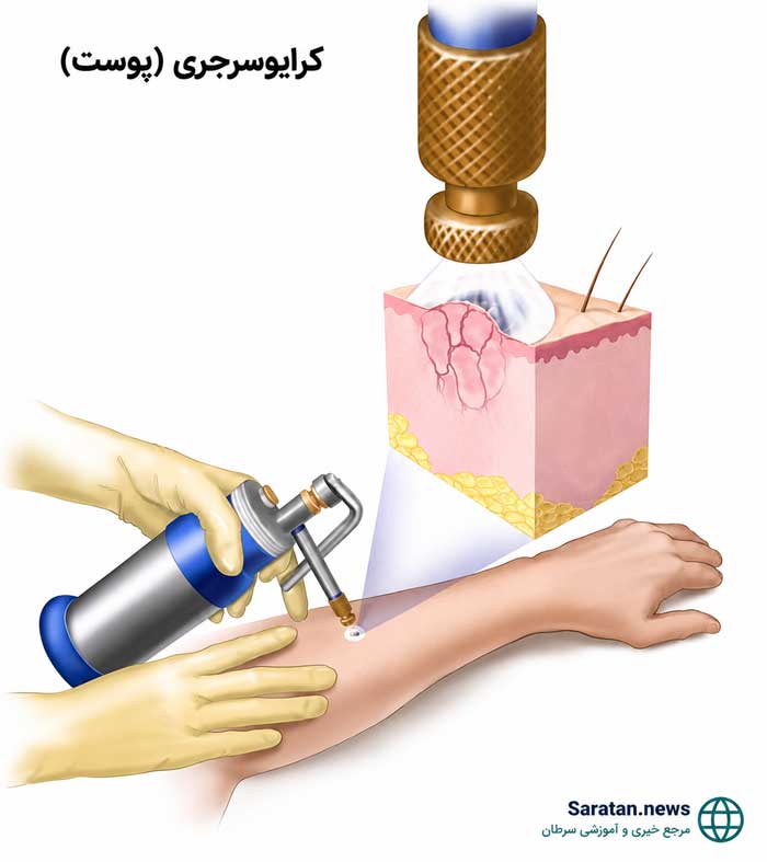 سرطان پوست چیست؟ علائم، علل، تشخیص و جدیدترین روشهای درمان سرطان پوست سرطان پوست چیست؟ علائم، علل، تشخیص و جدیدترین روشهای درمان سرطان پوست