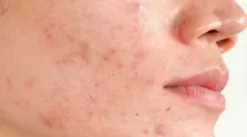 سیستم ایمنی بدنت را بررسی کن