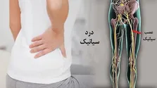 تنها ۱۰ درصد کمردردها به جراحی نیاز دارند