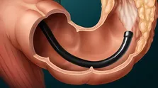 واکسن سرطان با کمترین عوارض در شرف فاز ۳ آزمایشات بالینی