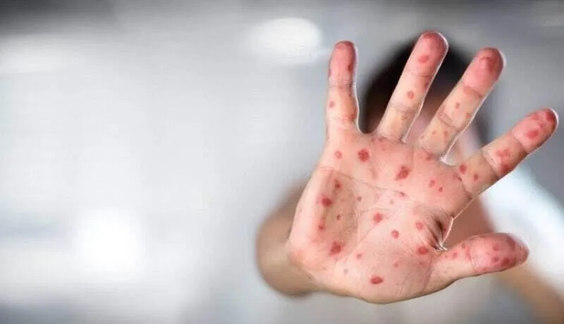 ابتلای بیش از ۵۰ هزار نفر در جهان به آبله میمون