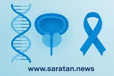 آزمایش خانگی سرطان پروستات؛ کاهش بیوپسی‌های غیرضروری با تست MPS2