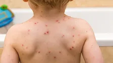 خطر نهضت ضد واکسن و بازگشت بیماری‌های واگیر / نگرانی از افزایش موارد سرخک و سرخجه