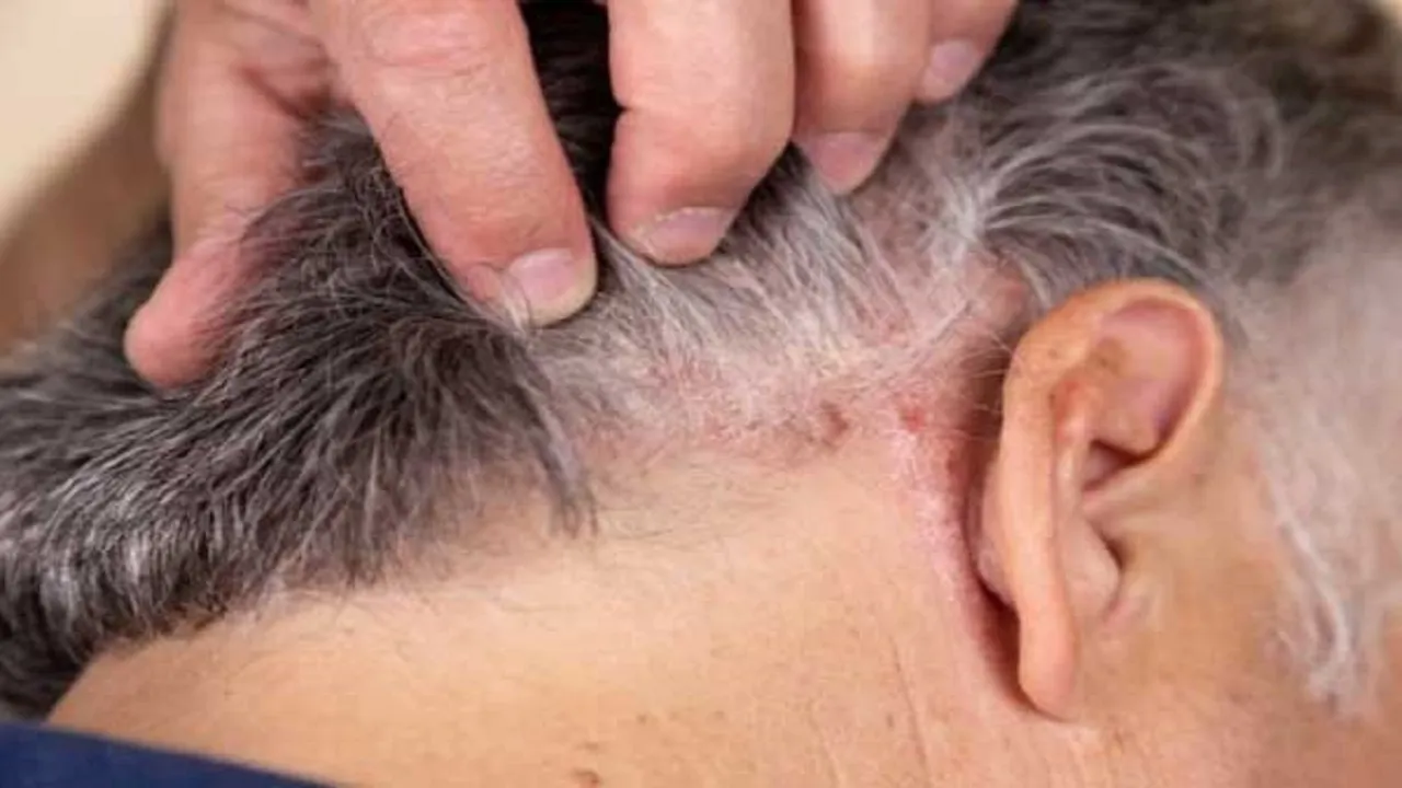 اگزمای پوست سر چیست و چطور درمان می‌شود؟
